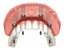 All on 4 Implant Image