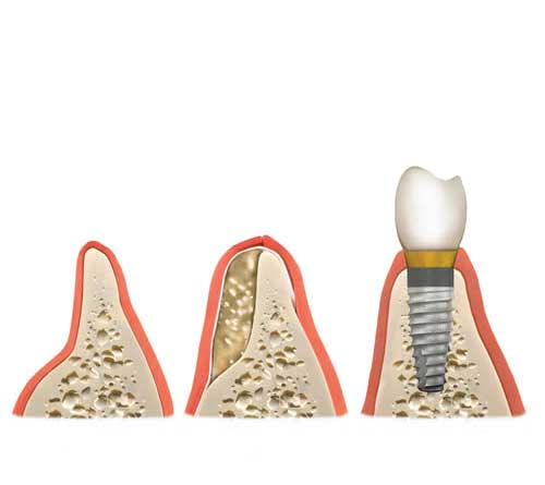 bone graft with implant