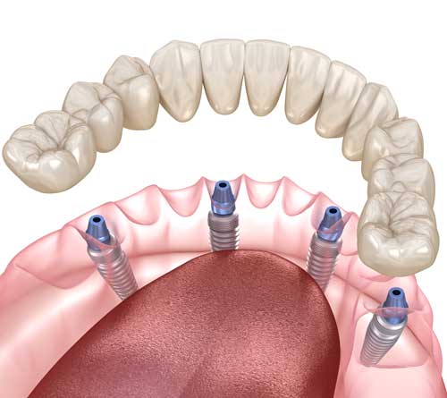 implant supported lower denture