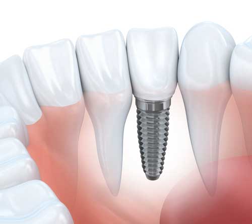 single dental implant