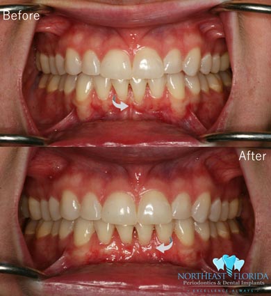 Before After Dental Treatment