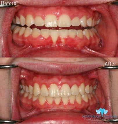 Before After Smile Makeover