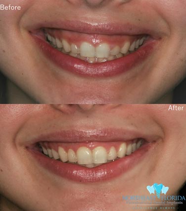 Before After Gummy Smile
