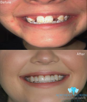 Before After Dental Implants